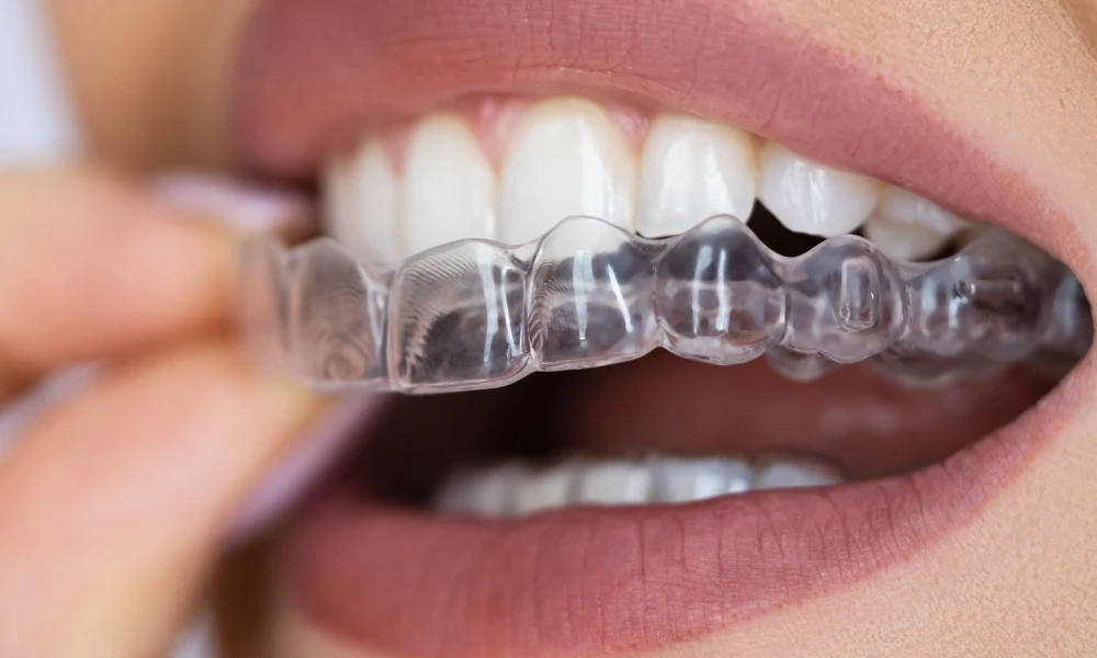 clear night guard being placed over teeth for teeth grinding protection