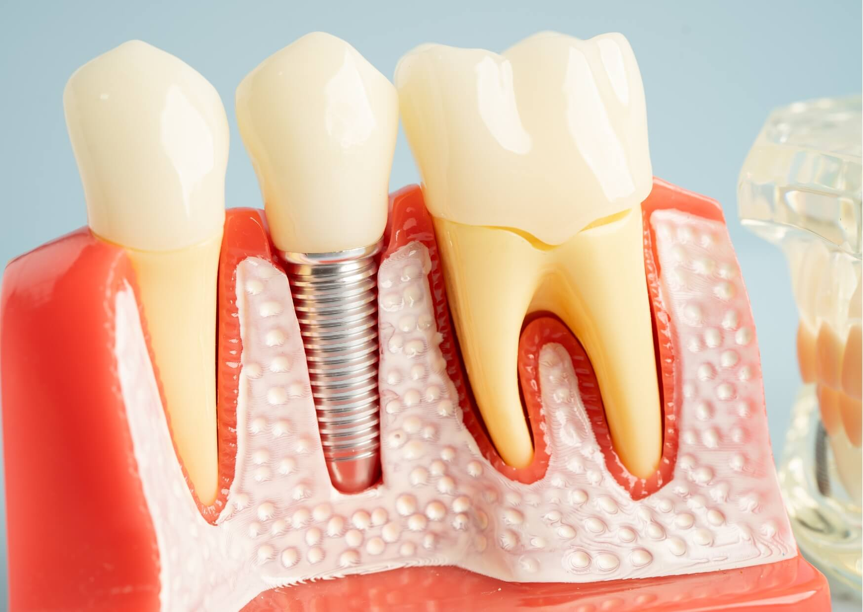 Dental model showing a dental implant positioned between natural teeth, illustrating the structure involved in dental implant removal procedures.