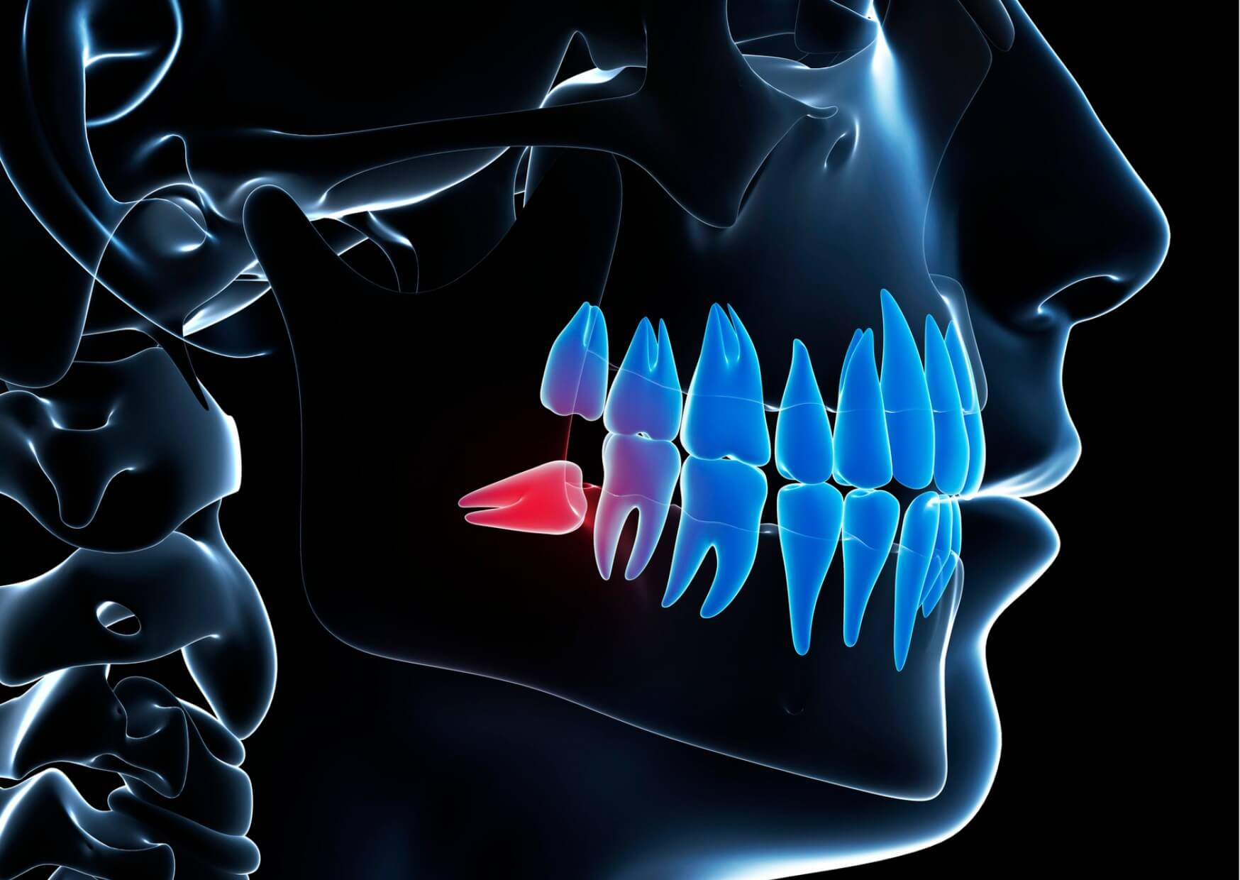 Illustration showing an impacted wisdom tooth beneath the gums, explaining how long a wisdom tooth takes to come in.