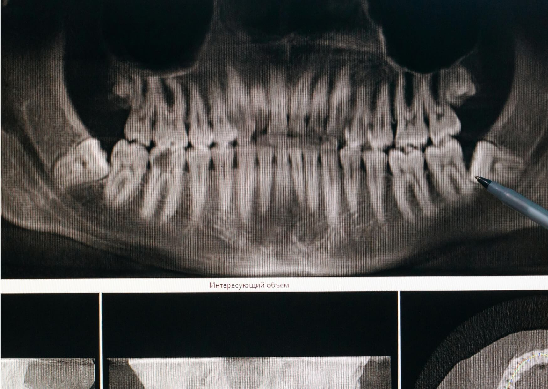 Panoramic dental X-ray showing impacted wisdom teeth, illustrating what a wisdom tooth coming in looks like beneath the gums.