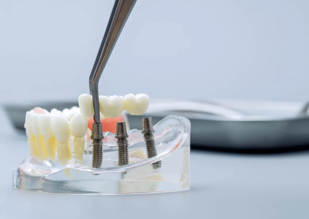 Dental implant model with multiple implant posts and a bridge, illustrating the stages involved in how long a tooth implant takes.