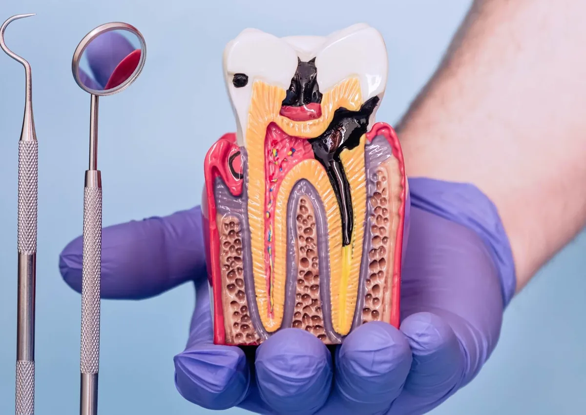Cross-section tooth model showing dark areas of decay that illustrate what a cavity can look like inside a tooth.