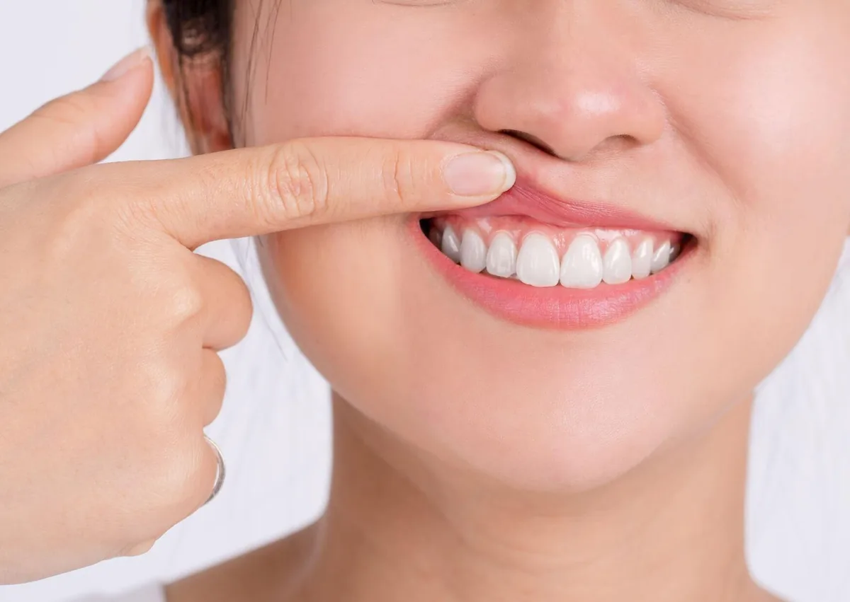 Close-up of a patient showing her gums while considering gummy smile treatment.
